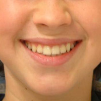 Ortodoncia con brackets de baja fricción