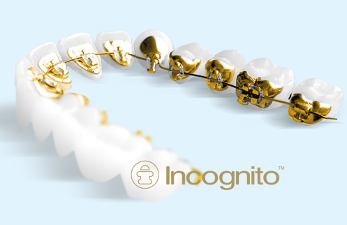 ortodoncia sistema Incognito
