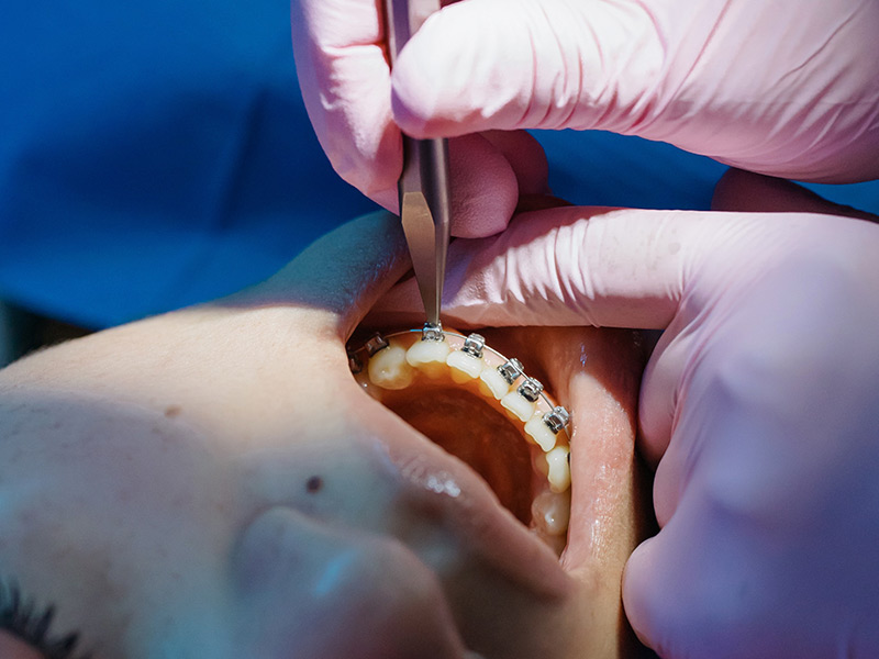 Cómo saber si necesito tratamiento de ortodoncia